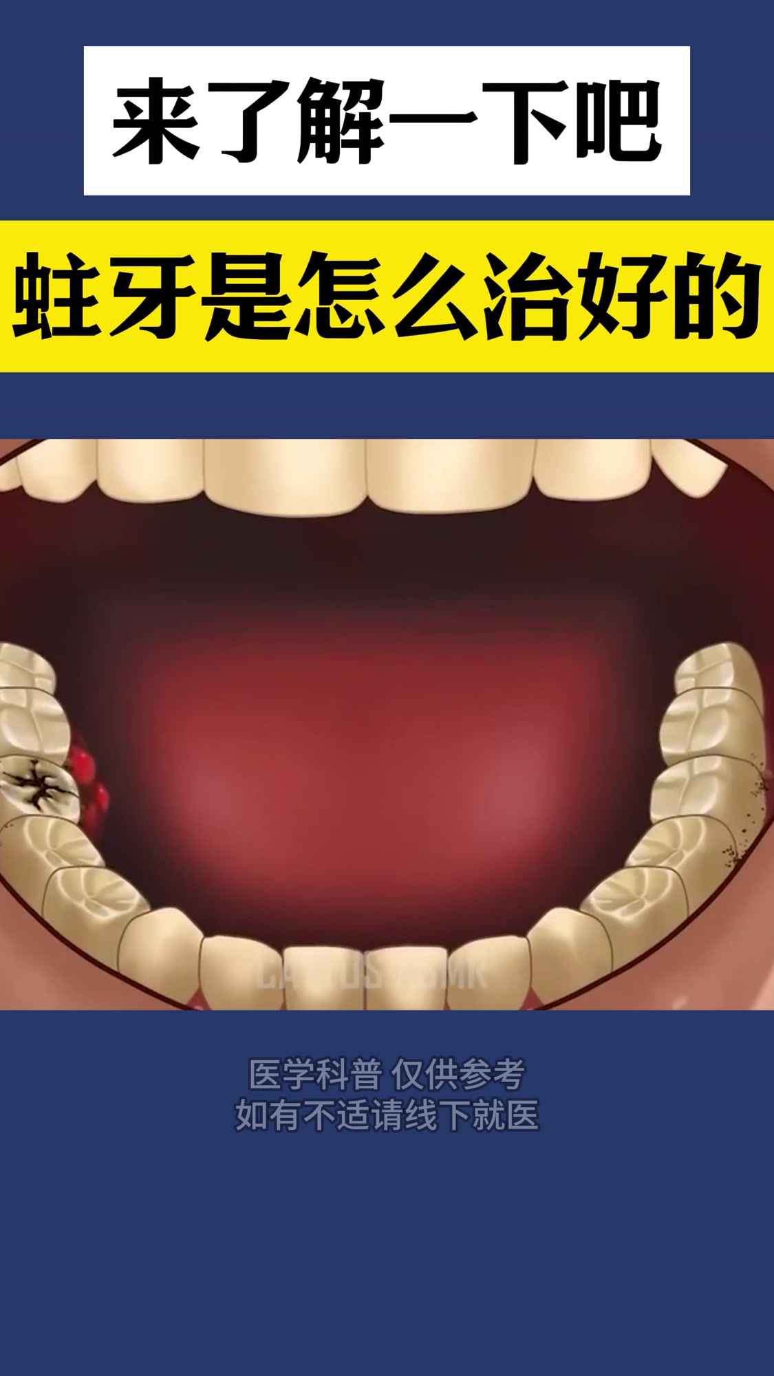 蛀牙是怎么治好的?一起了解一下吧。北京爵冠口腔