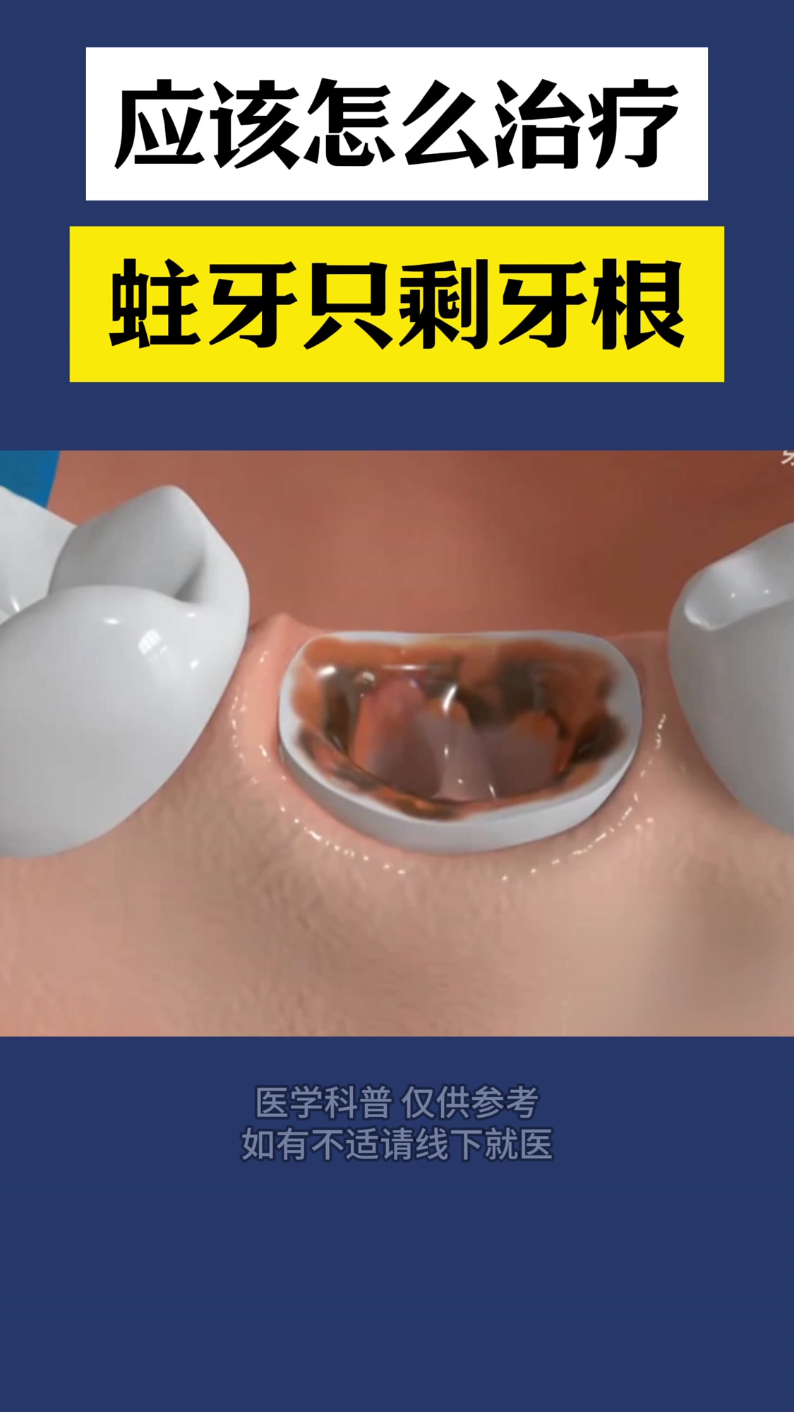 蛀牙只剩下残根应该怎么治疗?北京爵冠口腔